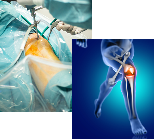 Knee Replacement