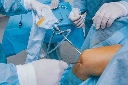 Knee Arthroscopy